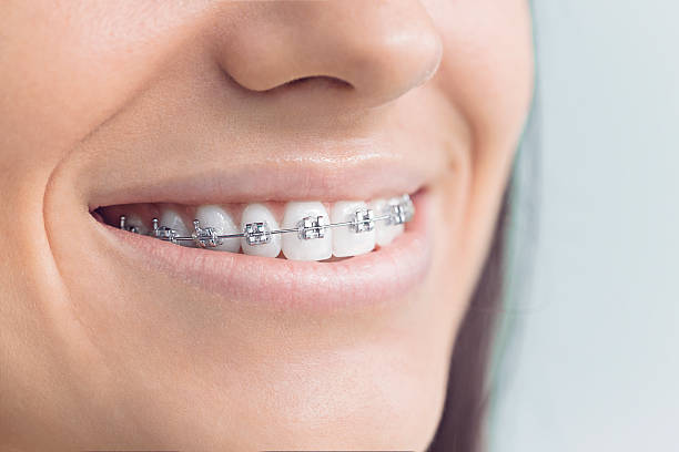 Best Teeth Whitening  in Mount Vernon, TX